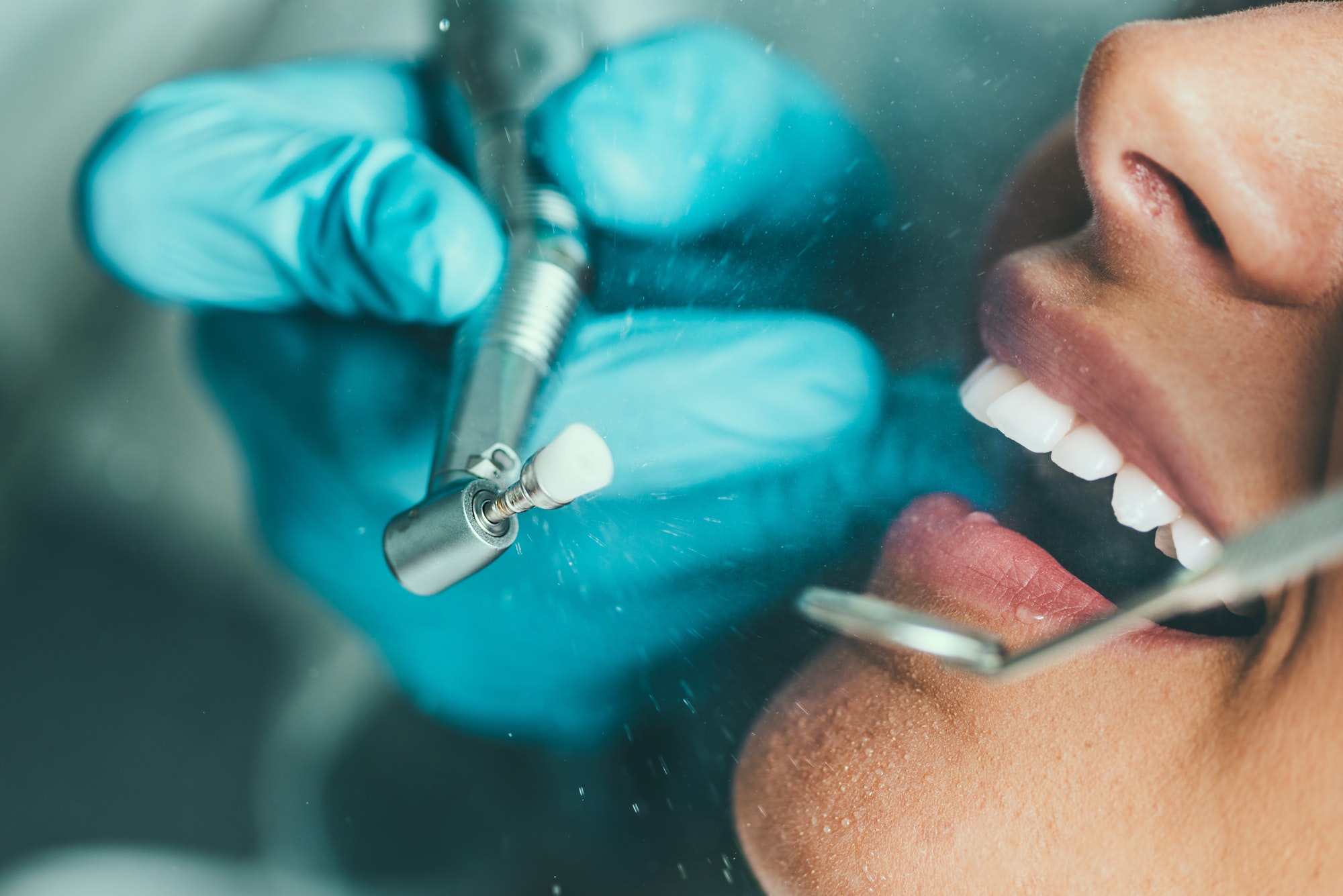 Dental drilling procedure