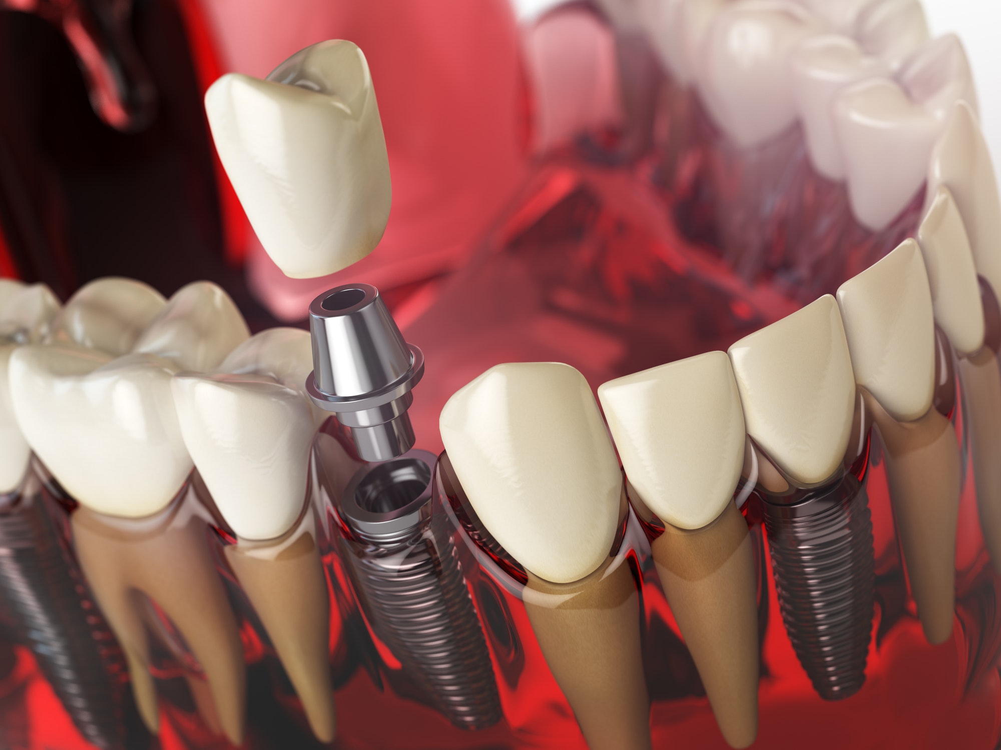 Tooth implant in the model human teeth, gums and denturas. Denta